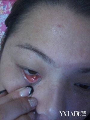 【图】眼皮长了个小肉粒切莫大意这三种情九游娱乐况(图3)